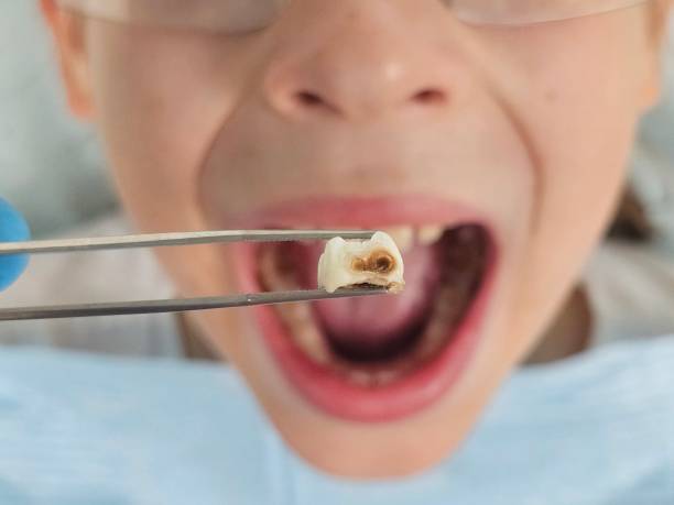 Best Emergency Dentist for Lost Fillings or Crowns in West Modesto, CA